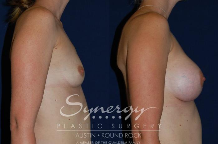 Before & After Breast Augmentation Case 70 View #1 View in Austin, TX