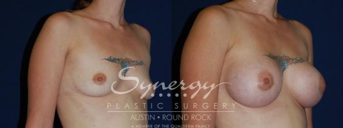 Before & After Breast Augmentation Case 70 View #2 View in Austin, TX