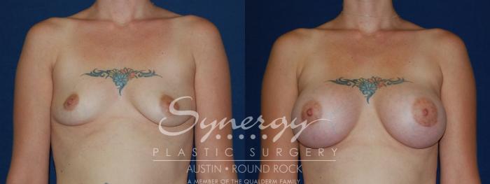 Before & After Breast Augmentation Case 70 View #3 View in Austin, TX