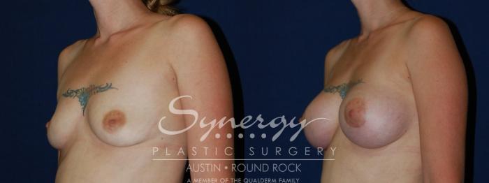 Before & After Breast Augmentation Case 70 View #4 View in Austin, TX