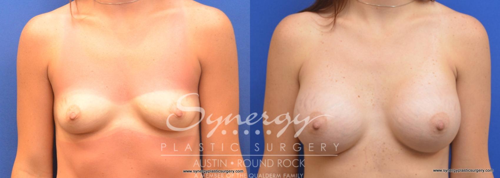 Before & After Breast Augmentation Case 700 View #1 View in Austin, TX