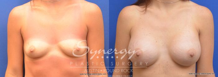 Before & After Breast Augmentation Case 700 View #1 View in Austin, TX
