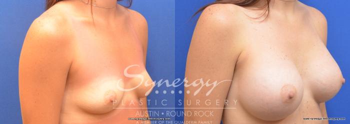 Before & After Breast Augmentation Case 700 View #2 View in Austin, TX