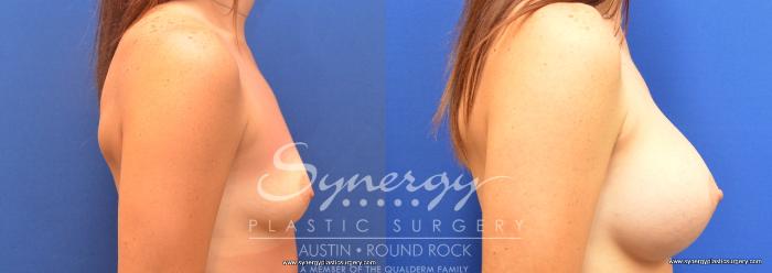 Before & After Breast Augmentation Case 700 View #3 View in Austin, TX