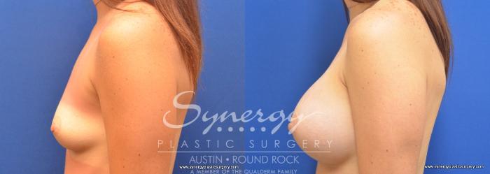 Before & After Breast Augmentation Case 700 View #5 View in Austin, TX