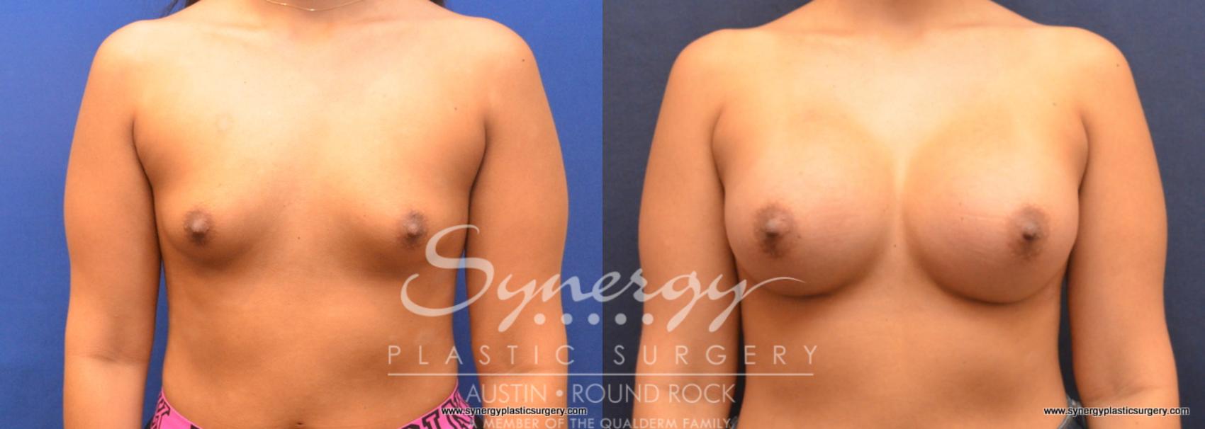 Before & After Breast Augmentation Case 705 View #1 View in Austin, TX