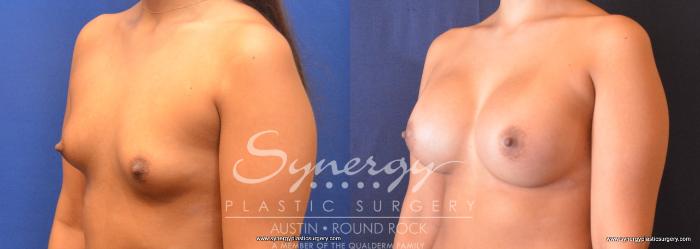 Before & After Breast Augmentation Case 705 View #2 View in Austin, TX