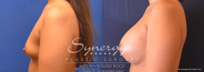 Before & After Breast Augmentation Case 705 View #3 View in Austin, TX