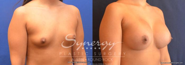 Before & After Breast Augmentation Case 705 View #4 View in Austin, TX