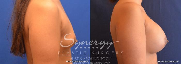 Before & After Breast Augmentation Case 705 View #5 View in Austin, TX