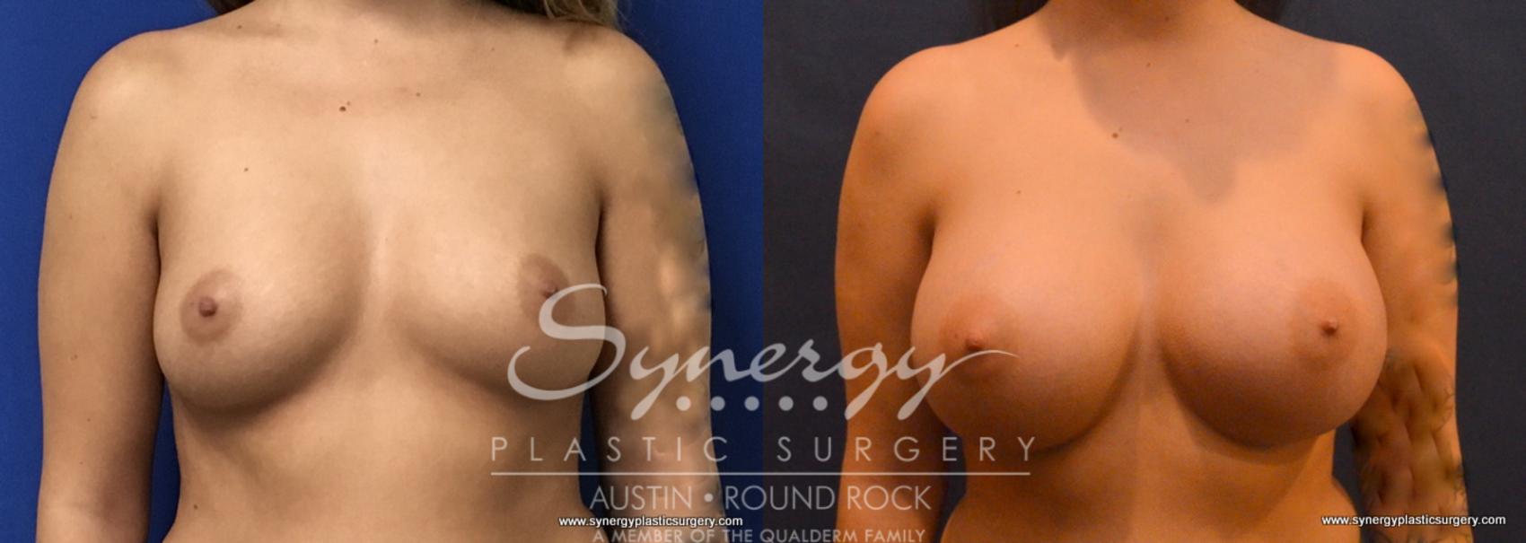 Before & After Breast Augmentation Case 710 View #1 View in Austin, TX