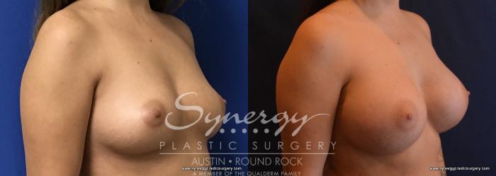 Before & After Breast Augmentation Case 710 View #2 View in Austin, TX