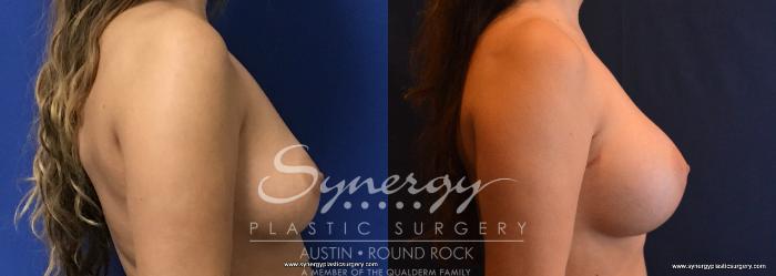 Before & After Breast Augmentation Case 710 View #3 View in Austin, TX