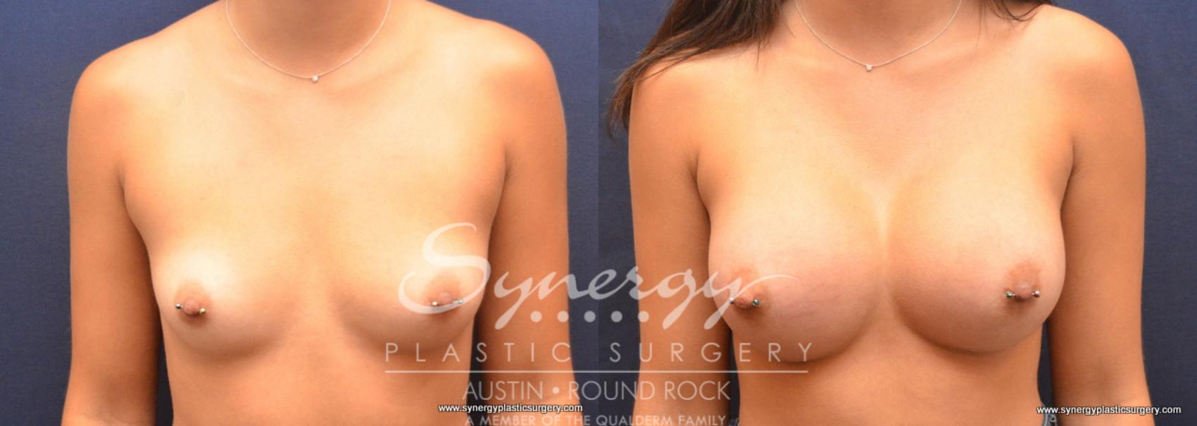 Before & After Breast Augmentation Case 711 View #1 View in Austin, TX