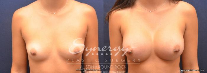 Before & After Breast Augmentation Case 711 View #1 View in Austin, TX