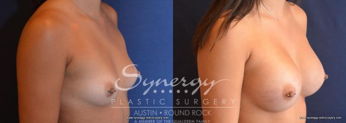 Before & After Breast Augmentation Case 711 View #2 View in Austin, TX