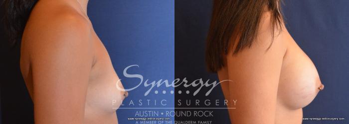 Before & After Breast Augmentation Case 711 View #3 View in Austin, TX