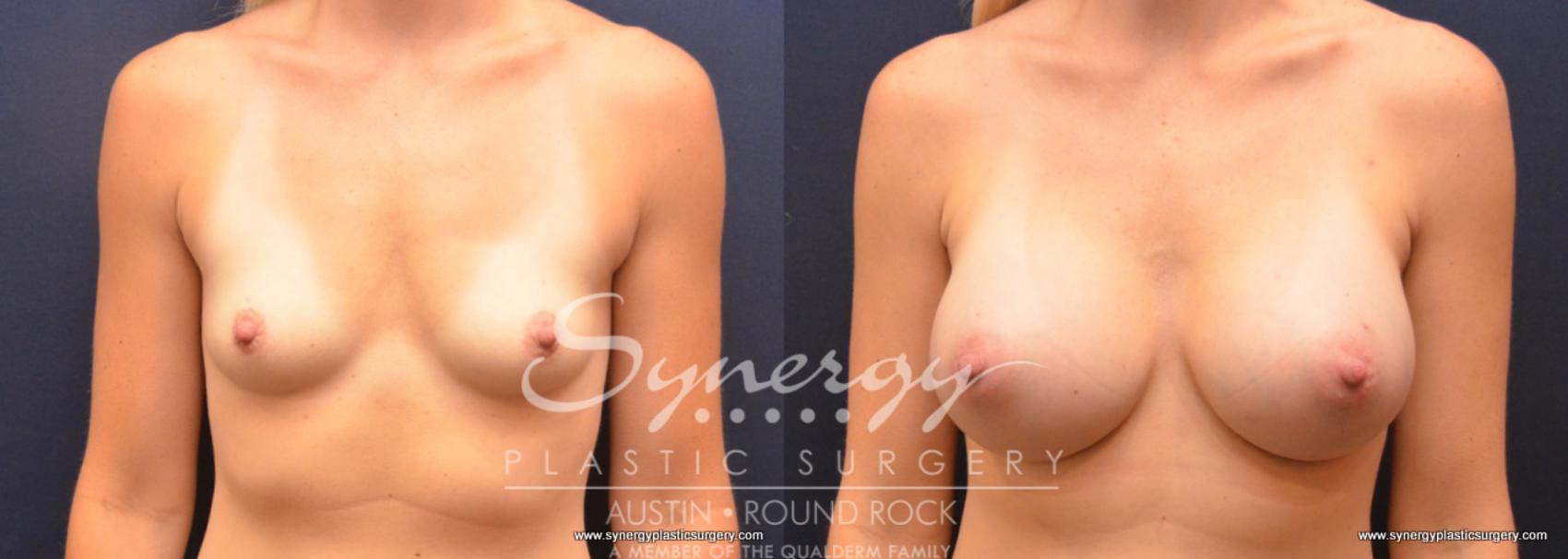 Before & After Breast Augmentation Case 712 View #1 View in Austin, TX