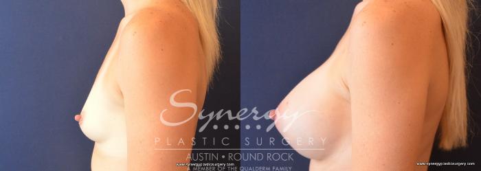 Before & After Breast Augmentation Case 712 View #3 View in Austin, TX