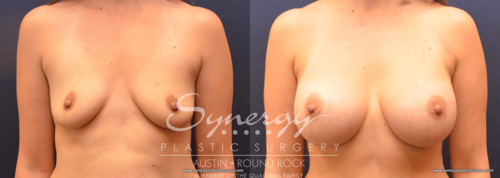 Before & After Breast Augmentation Case 720 View #1 View in Austin, TX