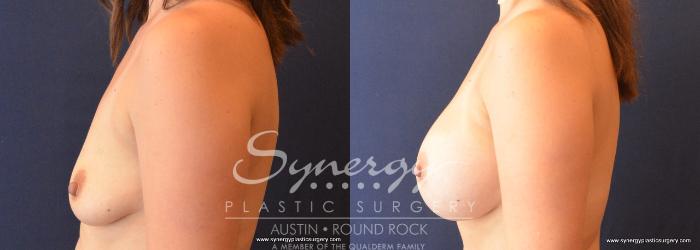 Before & After Breast Augmentation Case 720 View #2 View in Austin, TX