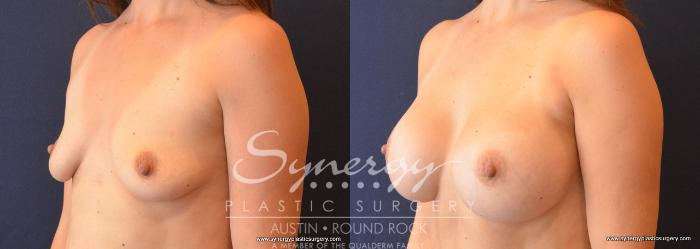 Before & After Breast Augmentation Case 720 View #3 View in Austin, TX