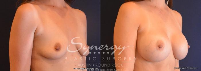 Before & After Breast Augmentation Case 720 View #4 View in Austin, TX