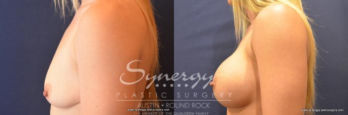 Before & After Breast Augmentation Case 725 View #2 View in Austin, TX
