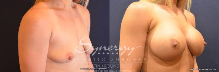 Before & After Breast Augmentation Case 725 View #4 View in Austin, TX