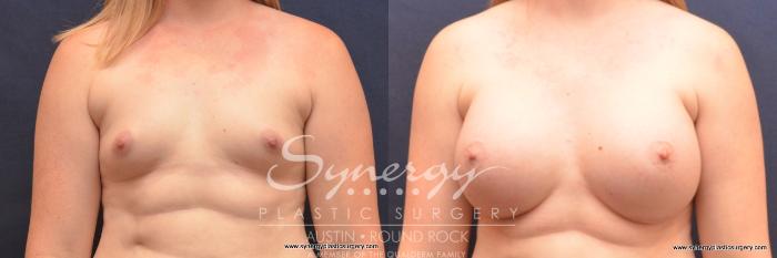Before & After Breast Augmentation Case 727 View #1 View in Austin, TX
