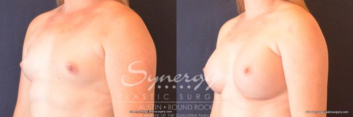 Before & After Breast Augmentation Case 727 View #2 View in Austin, TX