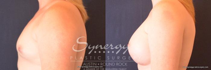 Before & After Breast Augmentation Case 727 View #3 View in Austin, TX