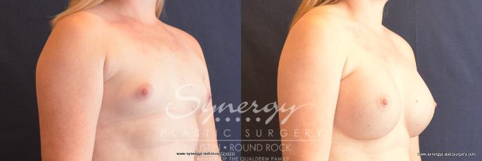 Before & After Breast Augmentation Case 727 View #4 View in Austin, TX