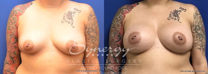 Before & After Breast Augmentation Case 728 View #1 View in Austin, TX
