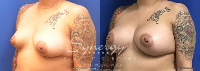 Before & After Breast Augmentation Case 728 View #2 View in Austin, TX