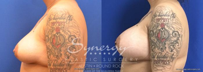Before & After Breast Augmentation Case 728 View #3 View in Austin, TX