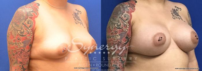 Before & After Breast Augmentation Case 728 View #4 View in Austin, TX