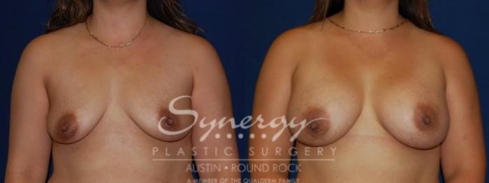 Before & After Breast Augmentation Case 73 View #1 View in Austin, TX