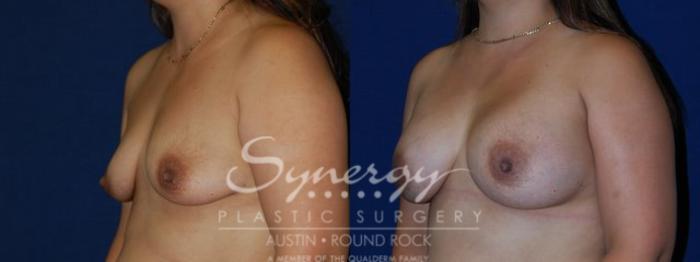 Before & After Breast Augmentation Case 73 View #2 View in Austin, TX