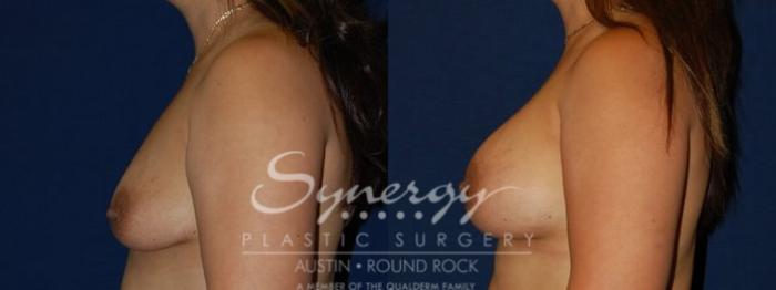 Before & After Breast Augmentation Case 73 View #3 View in Austin, TX