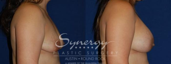 Before & After Breast Augmentation Case 73 View #4 View in Austin, TX