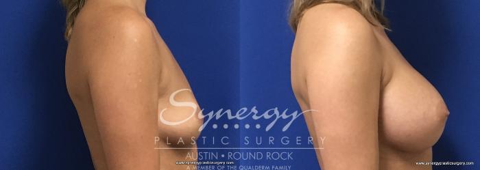 Before & After Breast Augmentation Case 730 View #2 View in Austin, TX