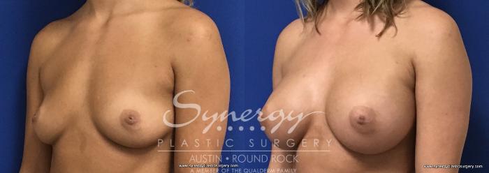 Before & After Breast Augmentation Case 730 View #3 View in Austin, TX