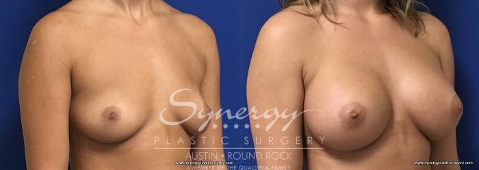 Before & After Breast Augmentation Case 730 View #5 View in Austin, TX