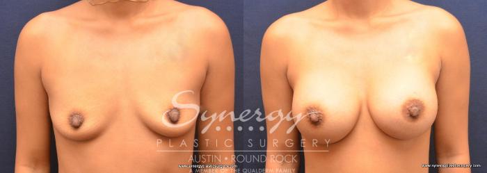 Before & After Breast Augmentation Case 731 View #1 View in Austin, TX