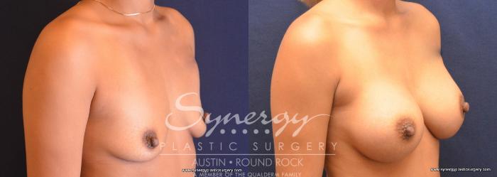 Before & After Breast Augmentation Case 731 View #2 View in Austin, TX