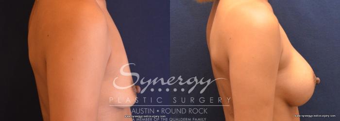 Before & After Breast Augmentation Case 731 View #3 View in Austin, TX