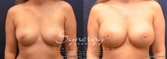 Before & After Breast Augmentation Case 732 View #1 View in Austin, TX