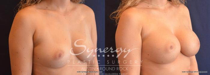 Before & After Breast Augmentation Case 732 View #2 View in Austin, TX