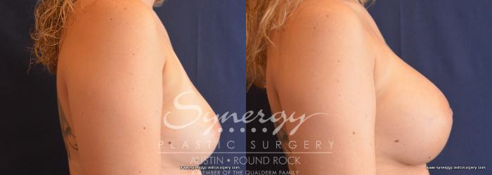 Before & After Breast Augmentation Case 732 View #3 View in Austin, TX